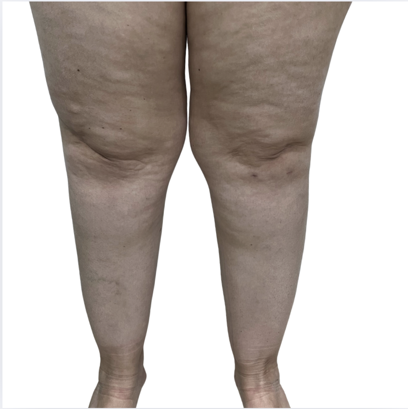 Curso de lipedema online